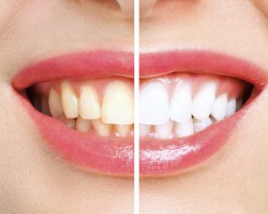 blanqueamiento de dientes amarillos en clinica viladent