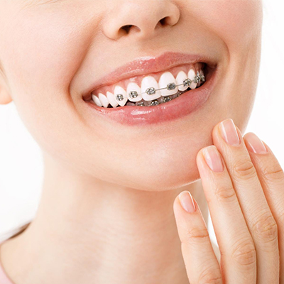 ortodoncia brackets clinica viladent montequinto