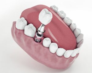 implantes clinica viladent montequinto
